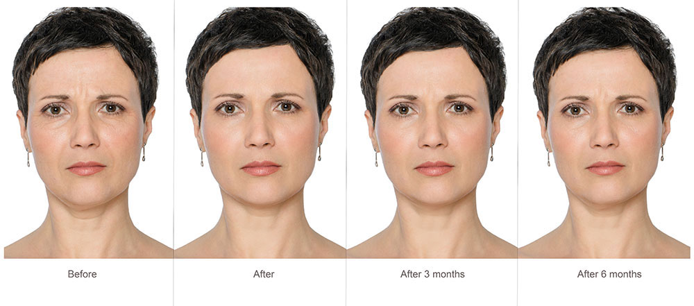 Botox before and after